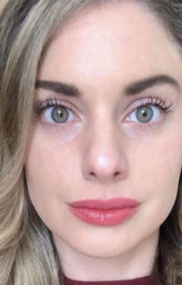 Laser Resurfacing