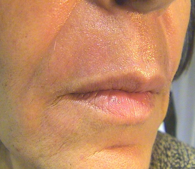 CO2 laser resurfacing Before & After Results Greenwich