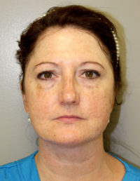 Laser Resurfacing