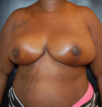Breast Reduction