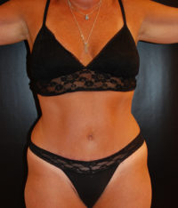 Tummy Tuck (Abdominoplasty)