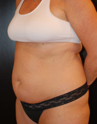 Tummy Tuck (Abdominoplasty)