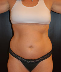 Tummy Tuck (Abdominoplasty)
