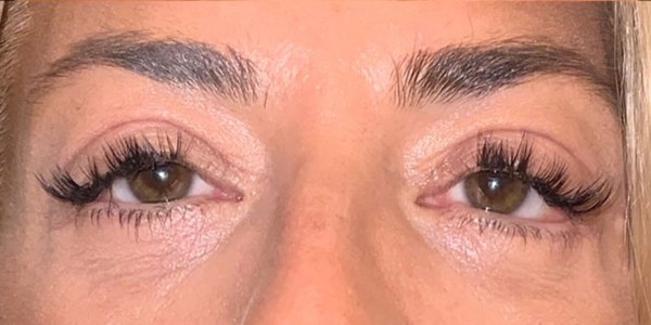 Blepharoplasty