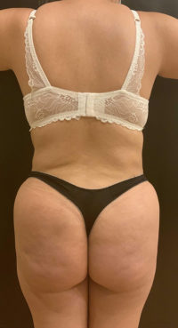 Brazilian Butt Lift