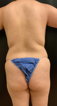 Brazilian Butt Lift