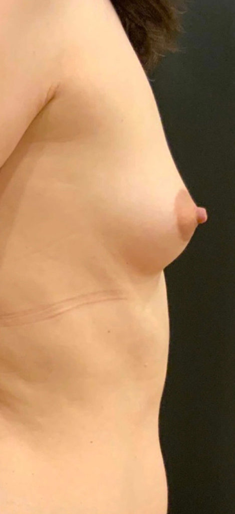 Breast Augmentation with Fat Grafting