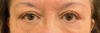 Blepharoplasty