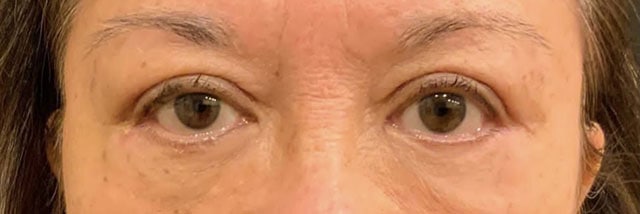 Blepharoplasty