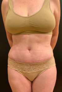 Tummy Tuck (Abdominoplasty)