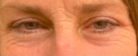 Blepharoplasty