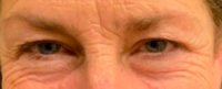 Blepharoplasty