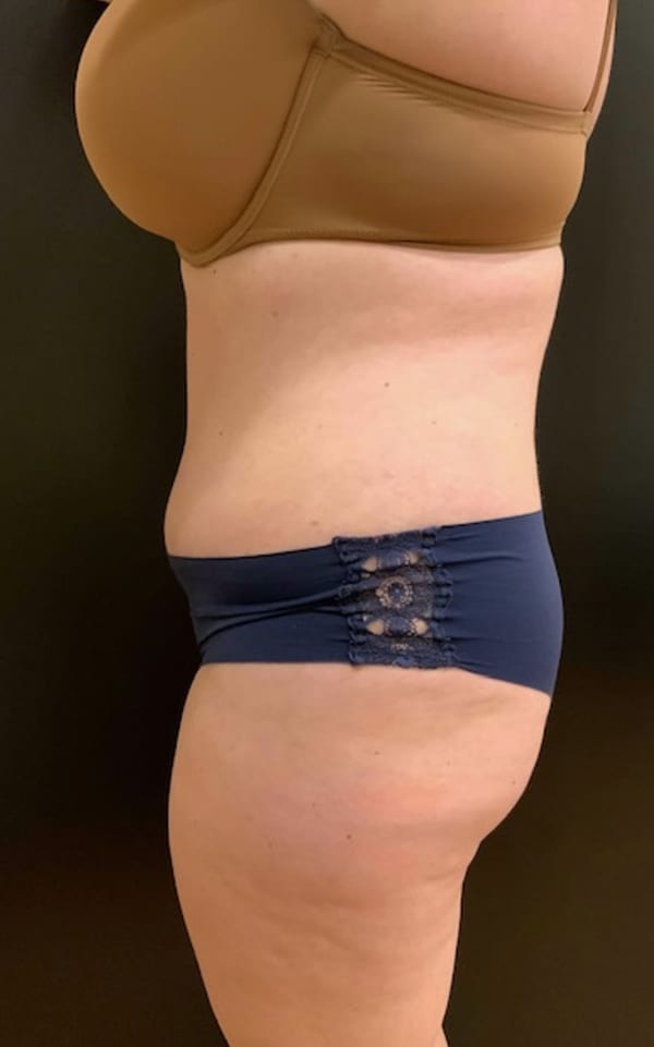 Tummy Tuck (Abdominoplasty)