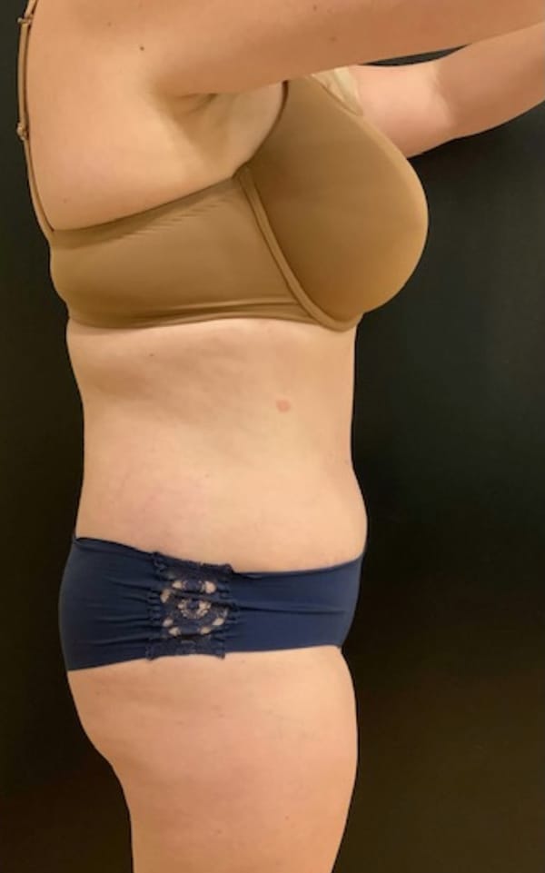 Tummy Tuck (Abdominoplasty)