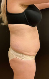 Tummy Tuck (Abdominoplasty)