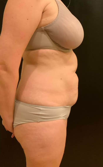 Tummy Tuck (Abdominoplasty)
