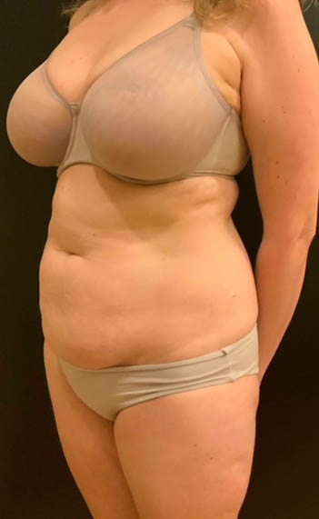 Tummy Tuck (Abdominoplasty)