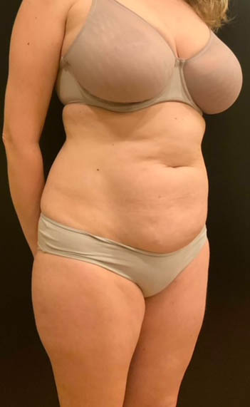 Tummy Tuck (Abdominoplasty)