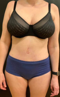 Tummy Tuck (Abdominoplasty)