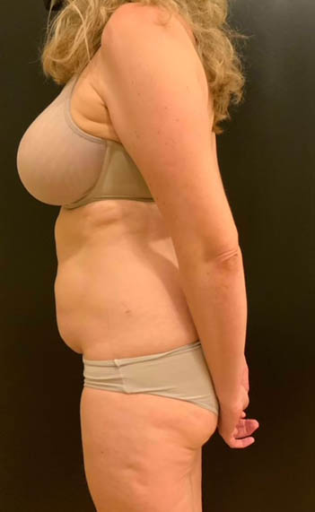 Tummy Tuck (Abdominoplasty)