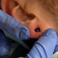 Earlobe Repair/Reduction