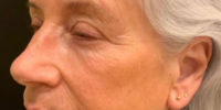 Laser Resurfacing