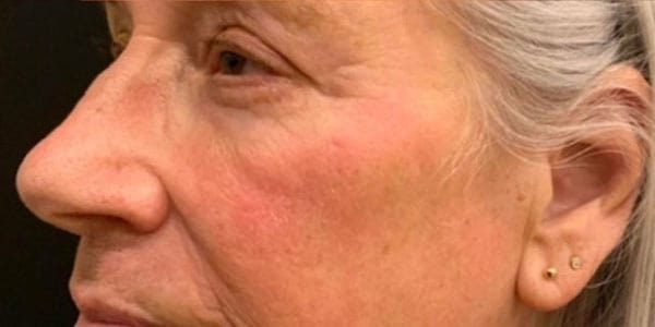Laser Resurfacing