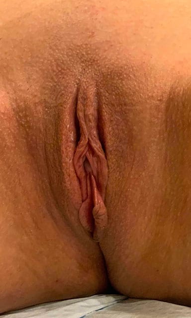 Labiaplasty