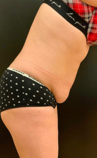 Tummy Tuck (Abdominoplasty)