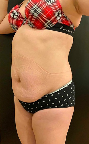 Tummy Tuck (Abdominoplasty)