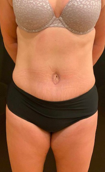 Tummy Tuck (Abdominoplasty)