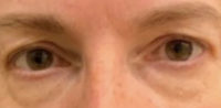 Blepharoplasty
