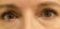 Blepharoplasty