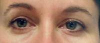 Blepharoplasty
