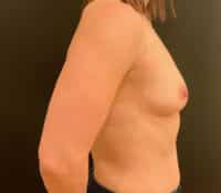 Breast Augmentation