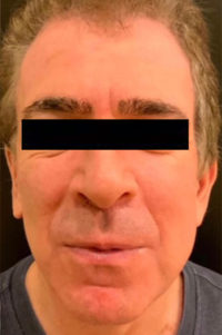 Facelift