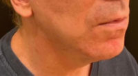 Lip Lift