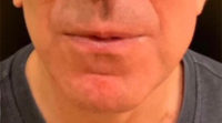 Lip Lift