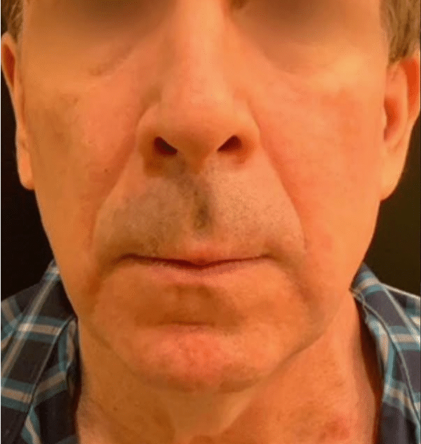 Lip Lift