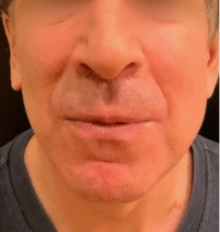 Lip Lift