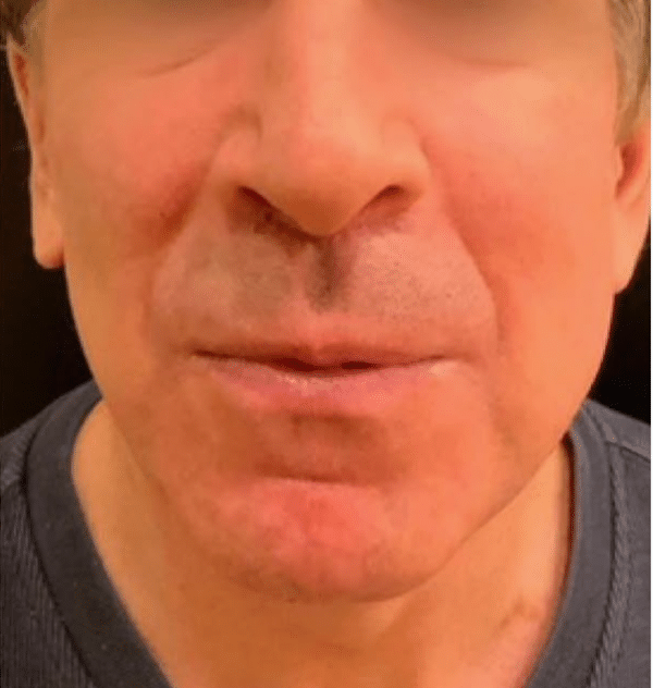 Lip Lift