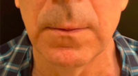Lip Lift
