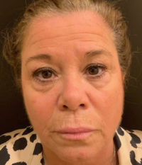 Blepharoplasty