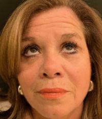 Blepharoplasty