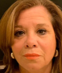 Blepharoplasty