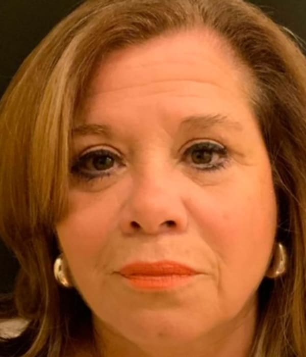 Blepharoplasty