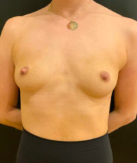 Breast Augmentation