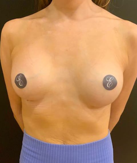 Breast Augmentation