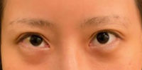Blepharoplasty