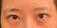 Blepharoplasty